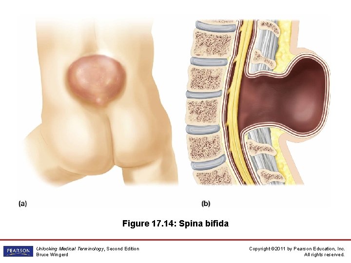 Figure 17. 14: Spina bifida Unlocking Medical Terminology, Second Edition Bruce Wingerd Copyright ©