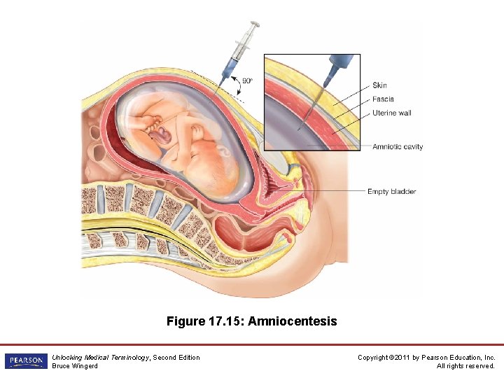 Figure 17. 15: Amniocentesis Unlocking Medical Terminology, Second Edition Bruce Wingerd Copyright © 2011