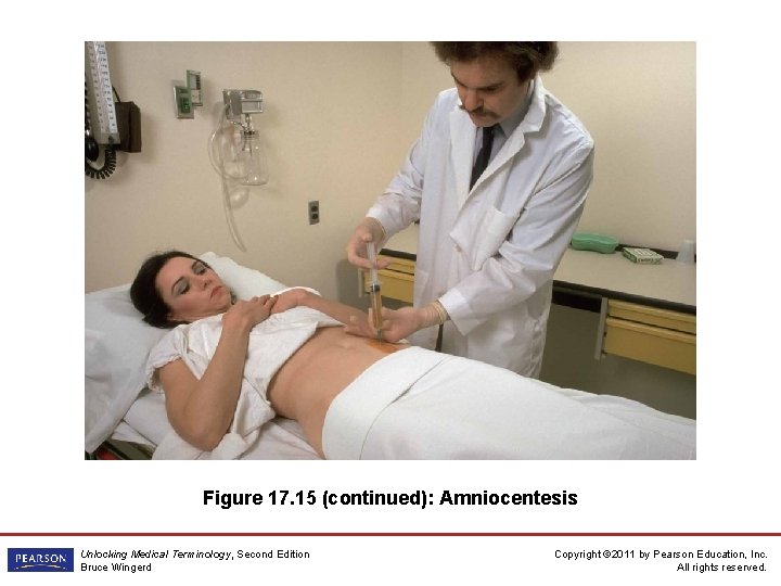 Figure 17. 15 (continued): Amniocentesis Unlocking Medical Terminology, Second Edition Bruce Wingerd Copyright ©