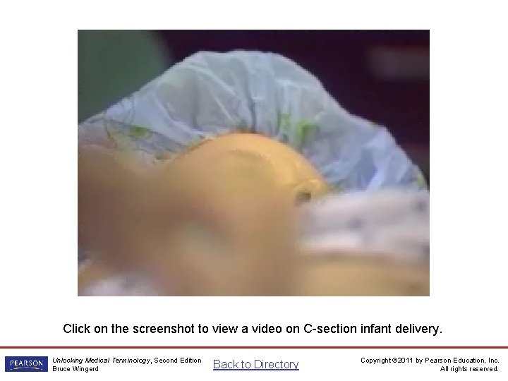 Delivery of Infant—C-section Video Click on the screenshot to view a video on C-section