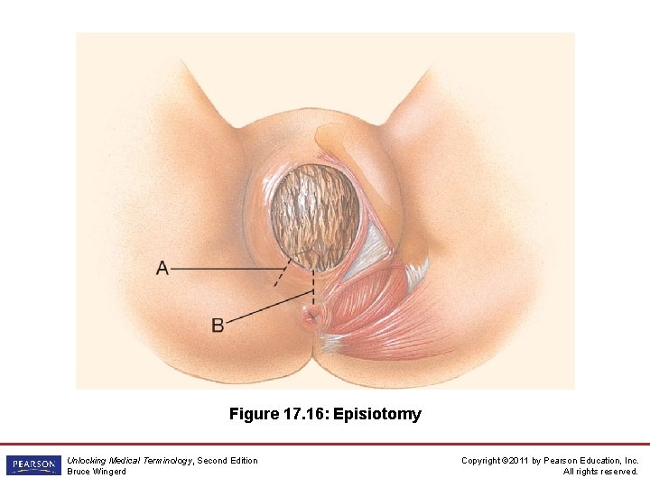 Figure 17. 16: Episiotomy Unlocking Medical Terminology, Second Edition Bruce Wingerd Copyright © 2011