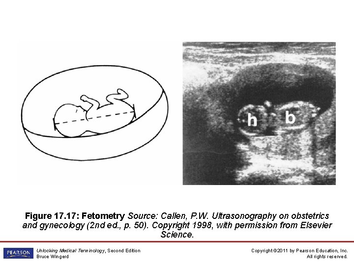 Figure 17. 17: Fetometry Source: Callen, P. W. Ultrasonography on obstetrics and gynecology (2