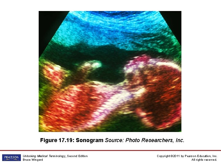 Figure 17. 19: Sonogram Source: Photo Researchers, Inc. Unlocking Medical Terminology, Second Edition Bruce