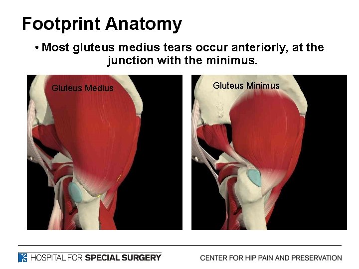 Footprint Anatomy • Most gluteus medius tears occur anteriorly, at the junction with the