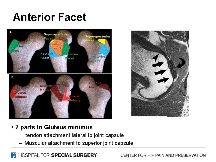 Anterior Facet • 2 parts to Gluteus minimus tendon attachment lateral to joint capsule