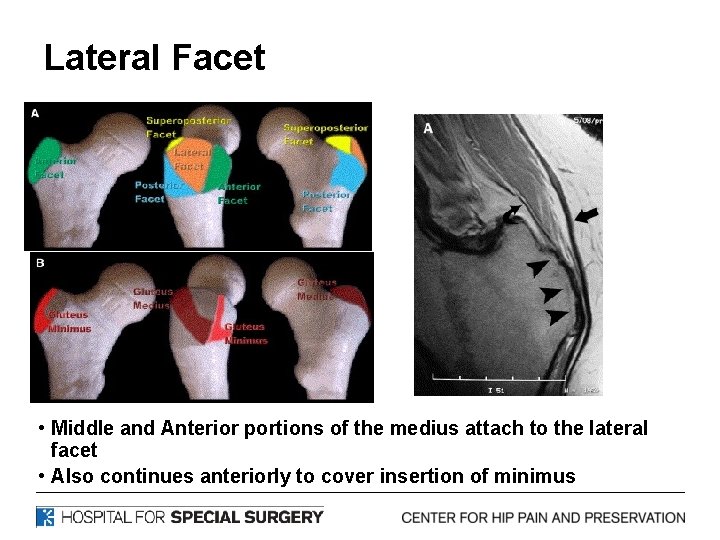 Lateral Facet • Middle and Anterior portions of the medius attach to the lateral