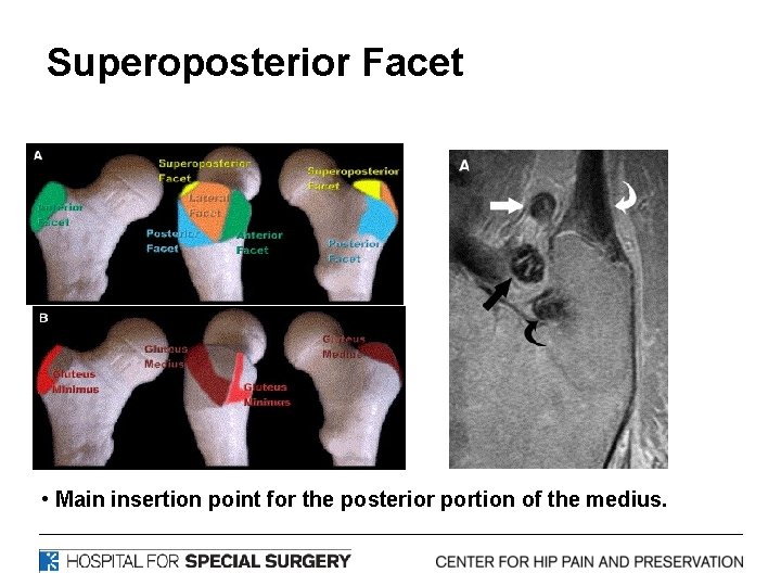 Superoposterior Facet • Main insertion point for the posterior portion of the medius. 