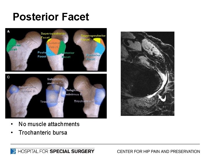 Posterior Facet • No muscle attachments • Trochanteric bursa 