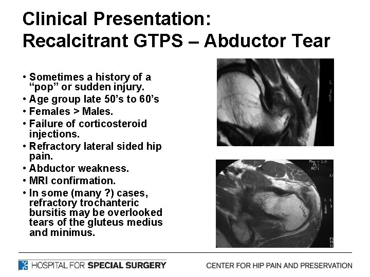 Clinical Presentation: Recalcitrant GTPS – Abductor Tear • Sometimes a history of a “pop”