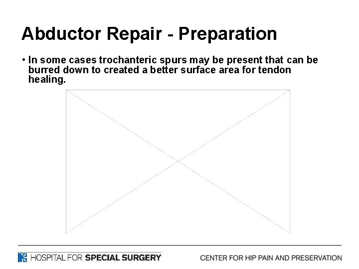 Abductor Repair - Preparation • In some cases trochanteric spurs may be present that