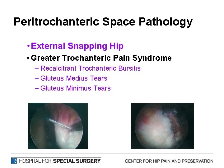 Peritrochanteric Space Pathology • External Snapping Hip • Greater Trochanteric Pain Syndrome – Recalcitrant