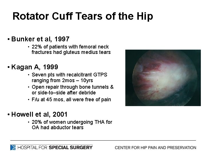 Rotator Cuff Tears of the Hip • Bunker et al, 1997 • 22% of