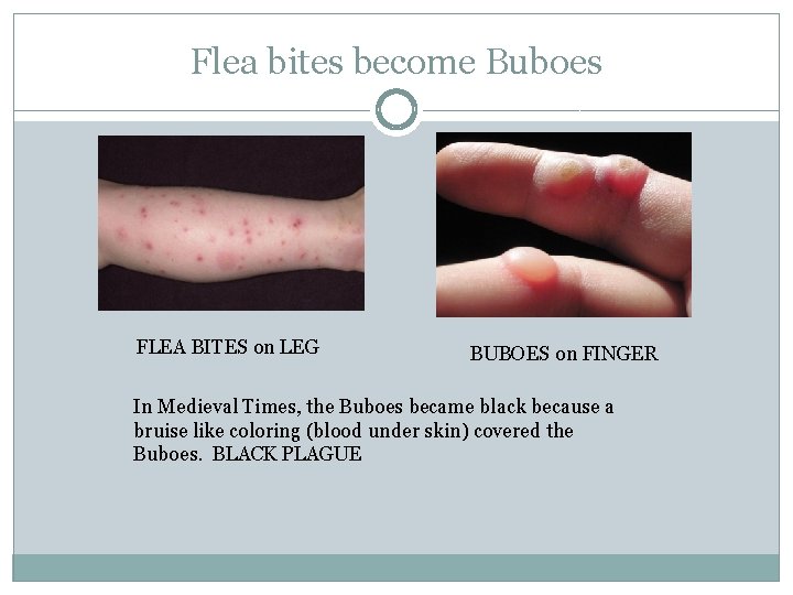 Flea bites become Buboes FLEA BITES on LEG BUBOES on FINGER In Medieval Times,