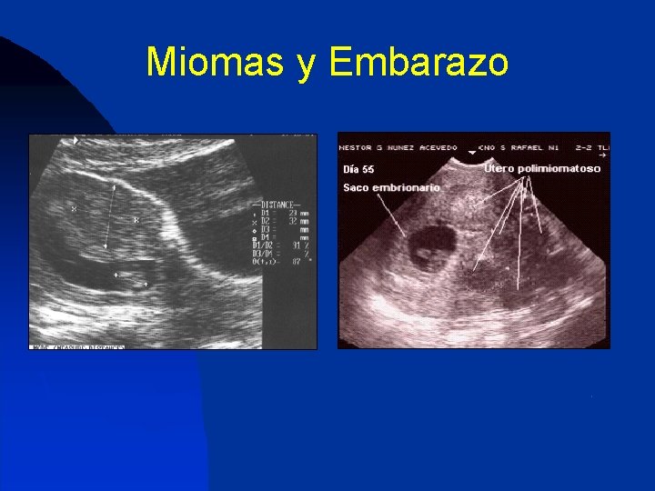 Miomas y Embarazo 