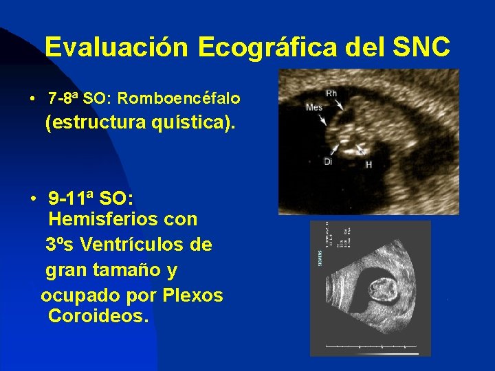 Evaluación Ecográfica del SNC • 7 -8ª SO: Romboencéfalo (estructura quística). • 9 -11ª