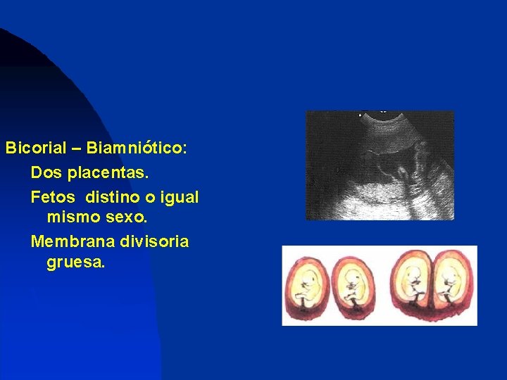 Bicorial – Biamniótico: Dos placentas. Fetos distino o igual mismo sexo. Membrana divisoria gruesa.