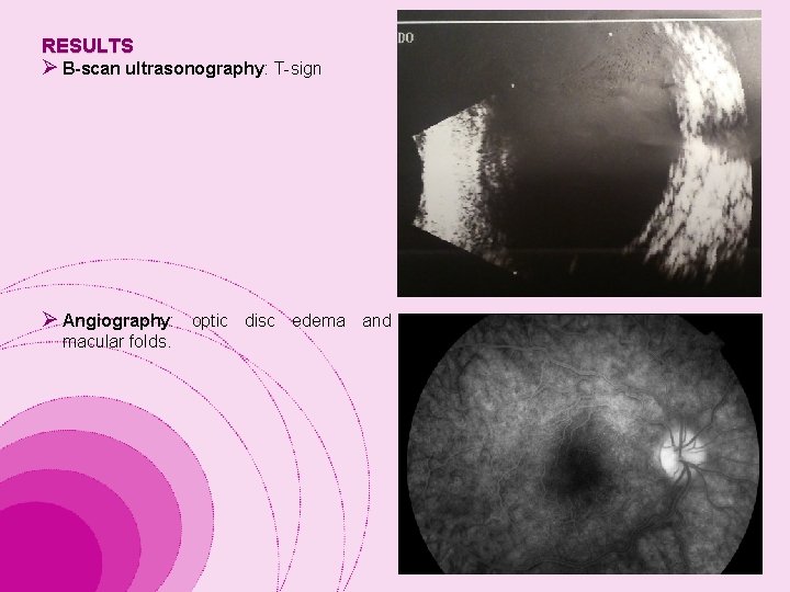 RESULTS Ø B-scan ultrasonography: T-sign Ø Angiography: macular folds. optic disc edema and 