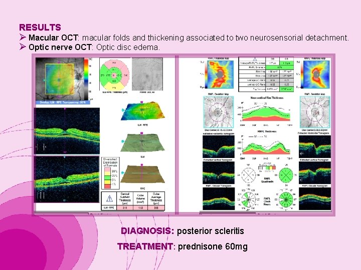 RESULTS Ø Macular OCT: macular folds and thickening associated to two neurosensorial detachment. Ø