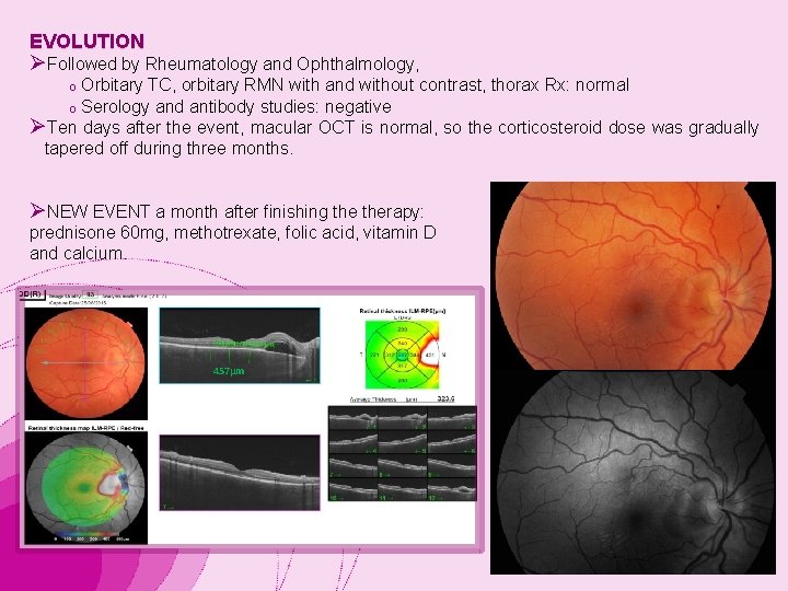 EVOLUTION ØFollowed by Rheumatology and Ophthalmology, Orbitary TC, orbitary RMN with and without contrast,