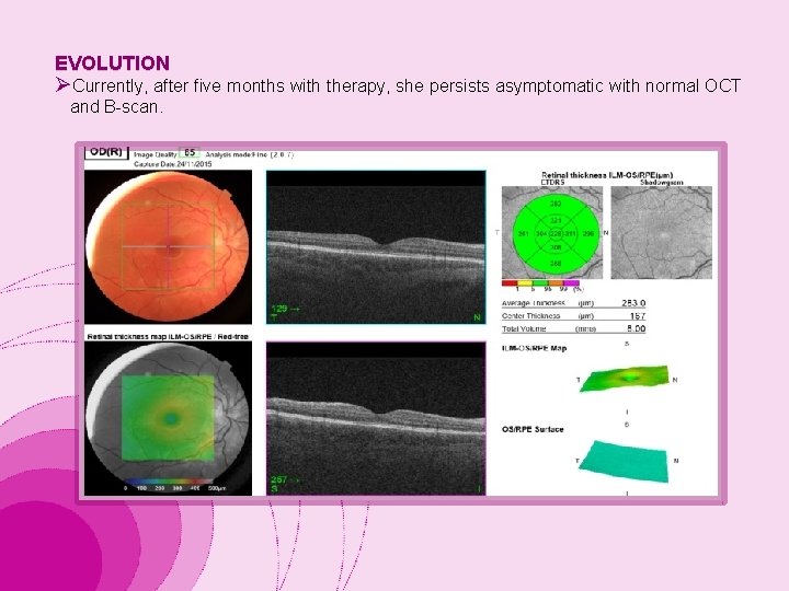 EVOLUTION ØCurrently, after five months with therapy, she persists asymptomatic with normal OCT and