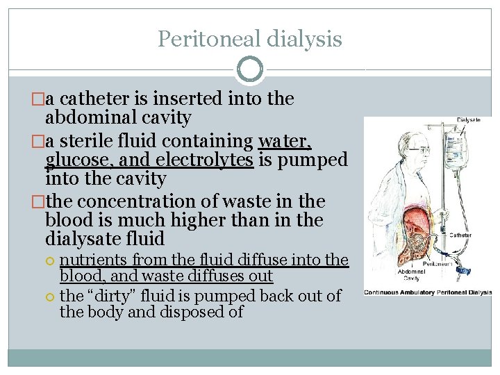 Peritoneal dialysis �a catheter is inserted into the abdominal cavity �a sterile fluid containing