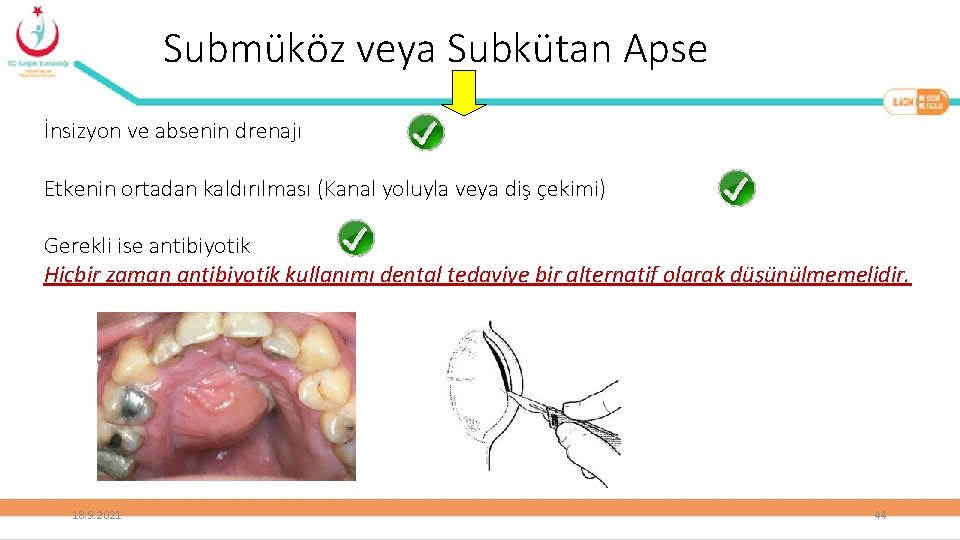 Submüköz veya Subkütan Apse İnsizyon ve absenin drenajı Etkenin ortadan kaldırılması (Kanal yoluyla veya