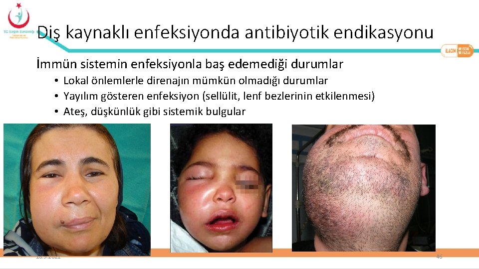 Diş kaynaklı enfeksiyonda antibiyotik endikasyonu İmmün sistemin enfeksiyonla baş edemediği durumlar • Lokal önlemlerle