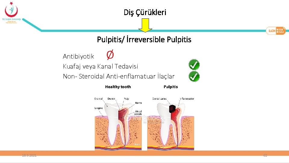 Diş Çürükleri Pulpitis/ İrreversible Pulpitis Ø Antibiyotik Kuafaj veya Kanal Tedavisi Non- Steroidal Anti-enflamatuar