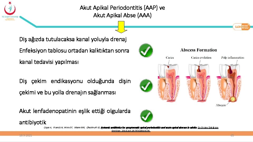 Akut Apikal Periodontitis (AAP) ve Akut Apikal Abse (AAA) Diş ağızda tutulacaksa kanal yoluyla