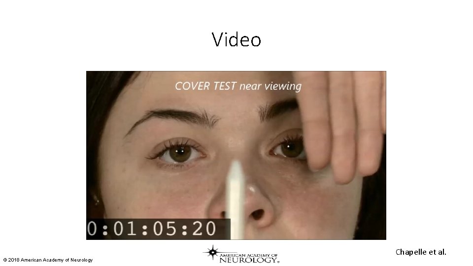 Video Chapelle et al. © 2018 American Academy of Neurology Video Chapelle et al. © 2018 American Academy of Neurology