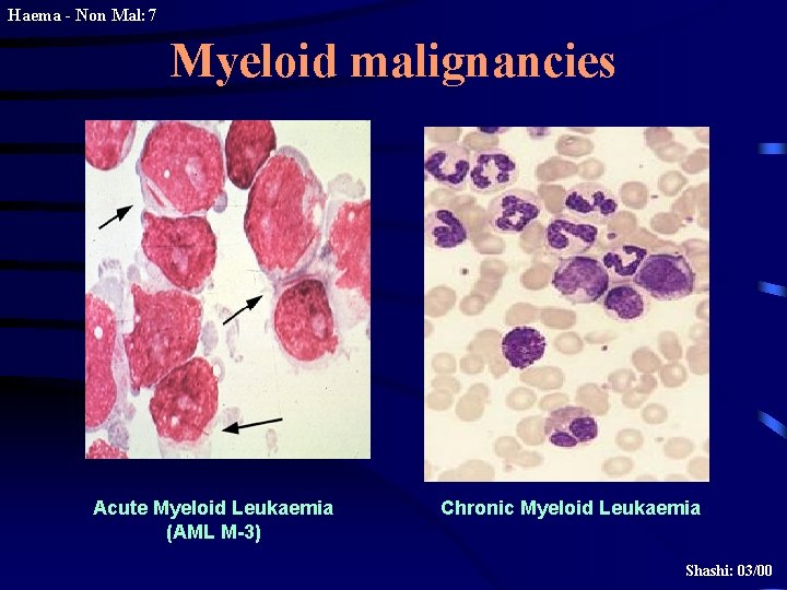 Haema - Non Mal: 7 Myeloid malignancies Acute Myeloid Leukaemia (AML M-3) Chronic Myeloid