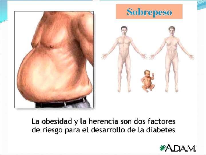 Sobrepeso Sobrepeso
