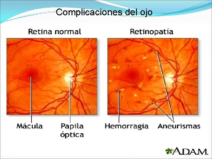 Complicaciones del ojo Complicaciones del ojo