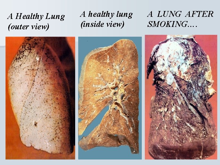 A Healthy Lung (outer view) A healthy lung (inside view) A LUNG AFTER SMOKING….