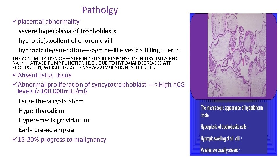 Patholgy üplacental abnormality severe hyperplasia of trophoblasts hydropic(swollen) of choronic villi hydropic degeneration---->grape-like vesicls