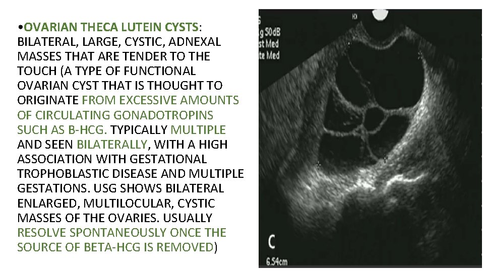  • OVARIAN THECA LUTEIN CYSTS: BILATERAL, LARGE, CYSTIC, ADNEXAL MASSES THAT ARE TENDER