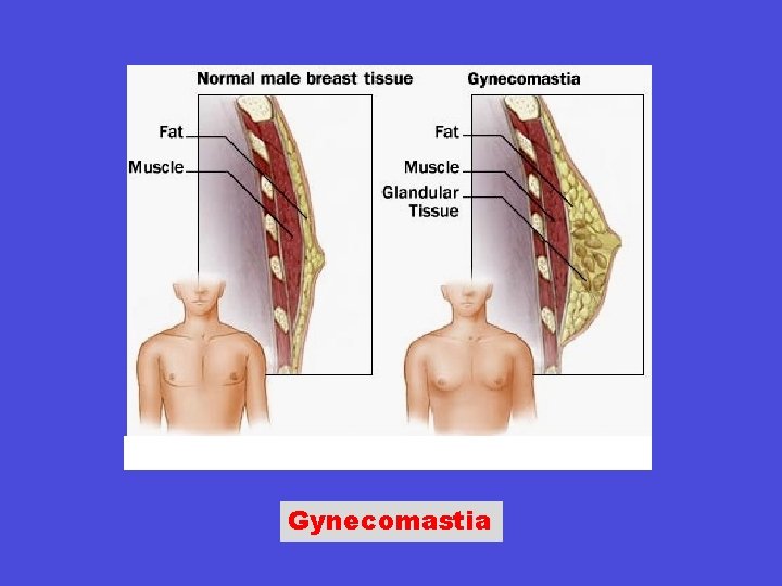 Gynecomastia 