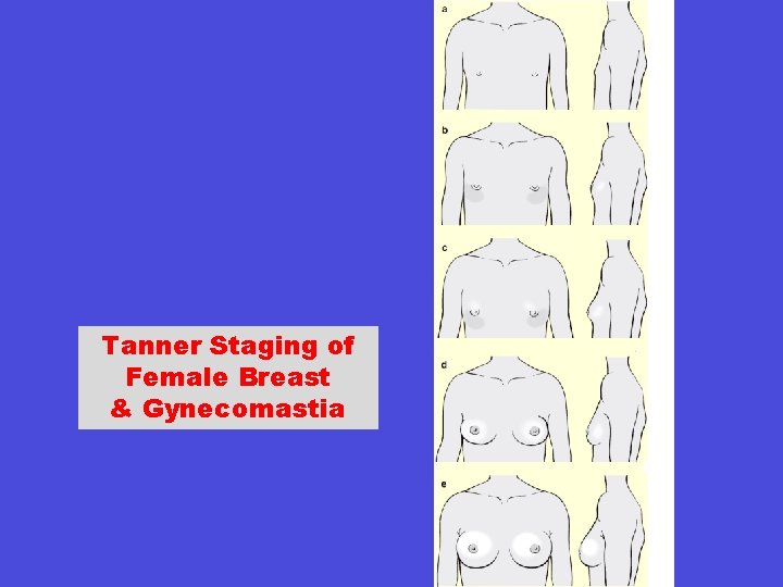 Tanner Staging of Female Breast & Gynecomastia 