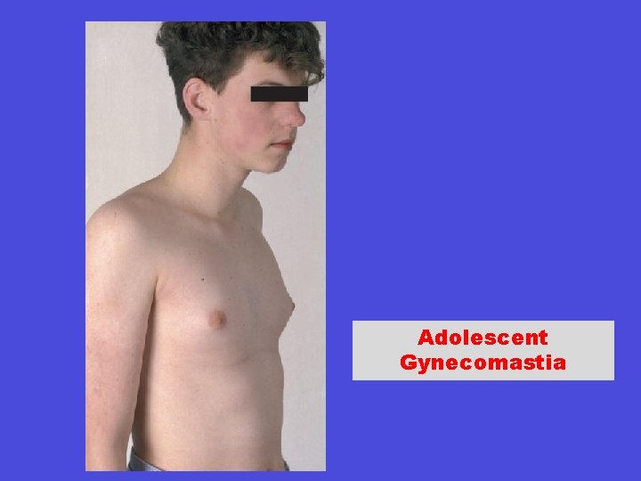 Adolescent Gynecomastia 