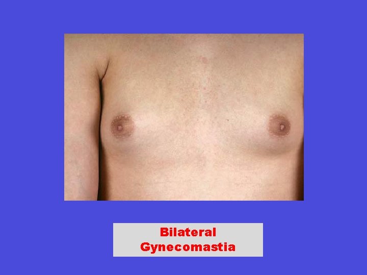 Bilateral Gynecomastia 