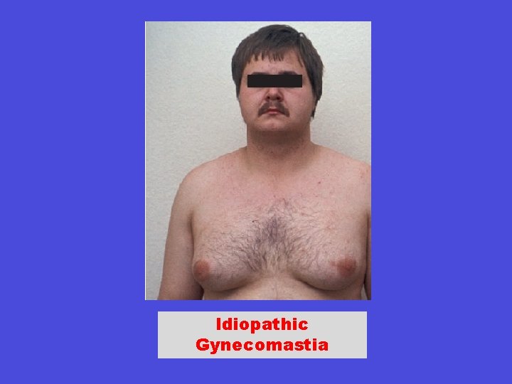 Idiopathic Gynecomastia 