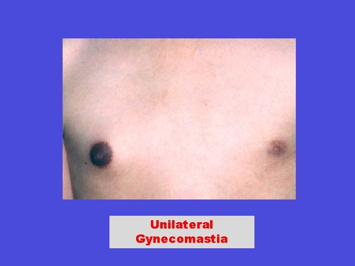 Unilateral Gynecomastia 