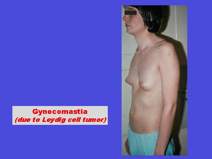 Gynecomastia (due to Leydig cell tumor) 