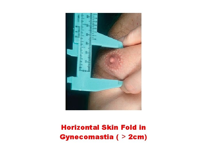 Horizontal Skin Fold in Gynecomastia ( ˃ 2 cm) 