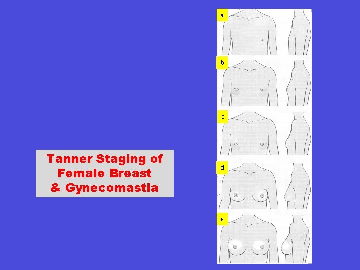 a b c Tanner Staging of Female Breast & Gynecomastia d e 