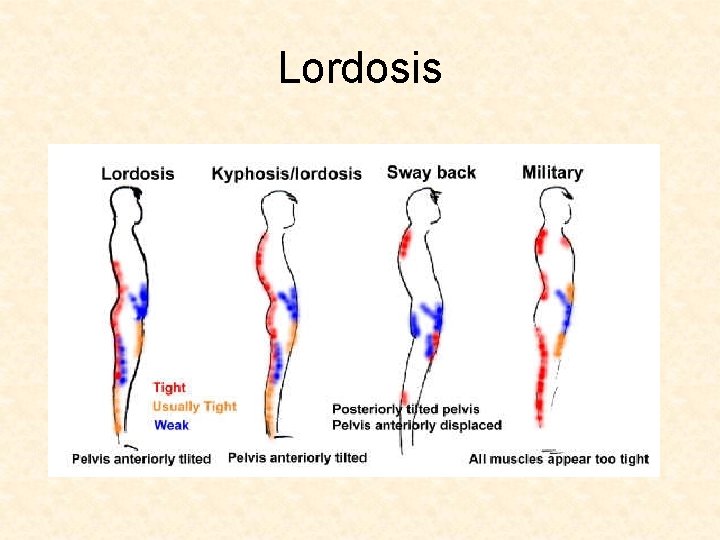 Lordosis Lordosis