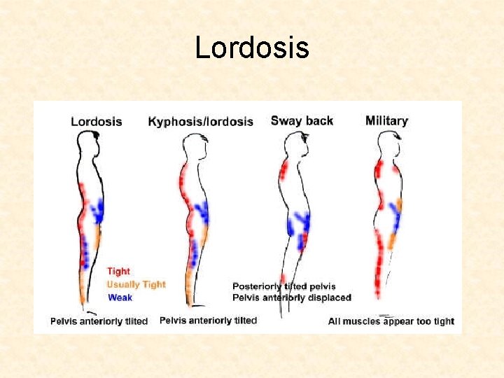 Lordosis 