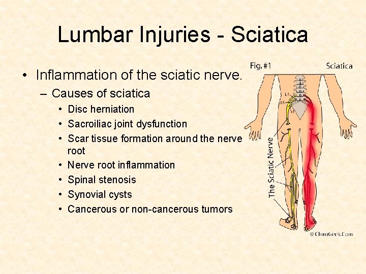 Lumbar Injuries - Sciatica • Inflammation of the sciatic nerve. – Causes of sciatica