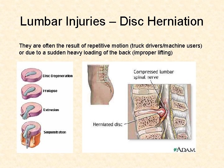 Lumbar Injuries – Disc Herniation They are often the result of repetitive motion (truck