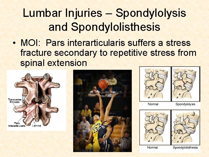 Lumbar Injuries – Spondylolysis and Spondylolisthesis • MOI: Pars interarticularis suffers a stress fracture